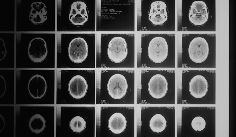 Cleveland Lab’s ‘Brain Shield’ Drug Shows Radiation Hope in Mice
