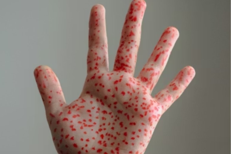 Measles Scare At Hyrum High Has Families On Edge