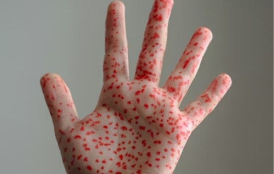 Measles Scare At Hyrum High Has Families On Edge