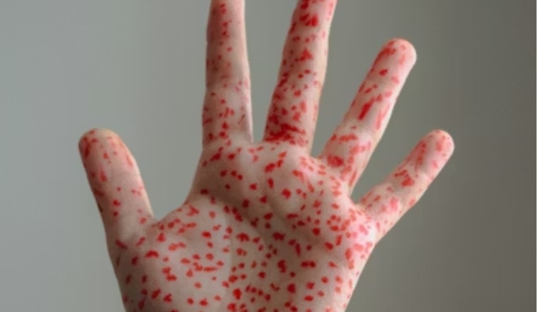 Measles Scare At Hyrum High Has Families On Edge
