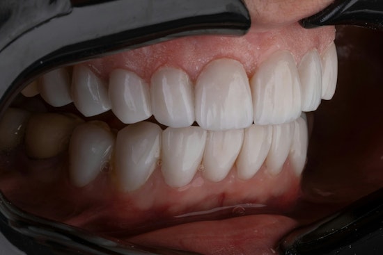 Memphis Woman Says Facebook Veneers Wrecked Her Smile