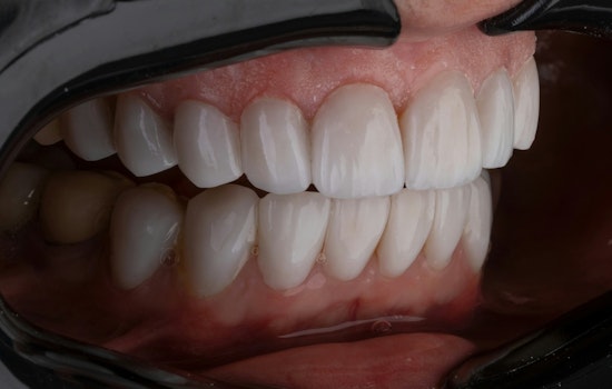 Memphis Woman Says Facebook Veneers Wrecked Her Smile