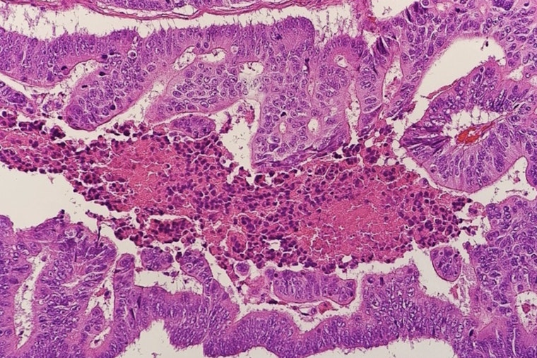 NYU Doc Sounds Alarm as Colon Cancer Stalks Younger New Yorkers