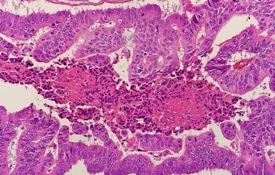 NYU Doc Sounds Alarm as Colon Cancer Stalks Younger New Yorkers