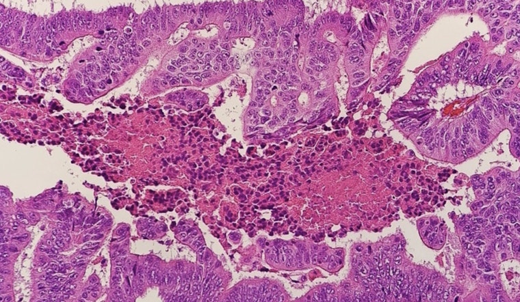 NYU Doc Sounds Alarm as Colon Cancer Stalks Younger New Yorkers