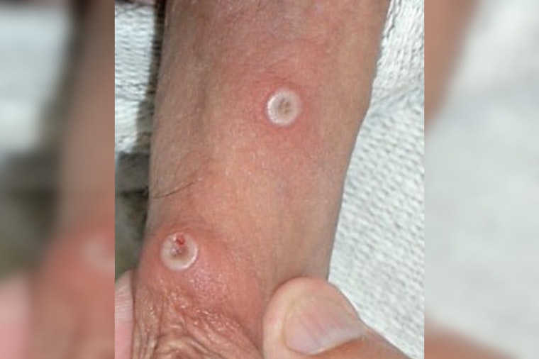Rare Mpox Strain Lands In St. Louis As Missouri Confirms First Cases