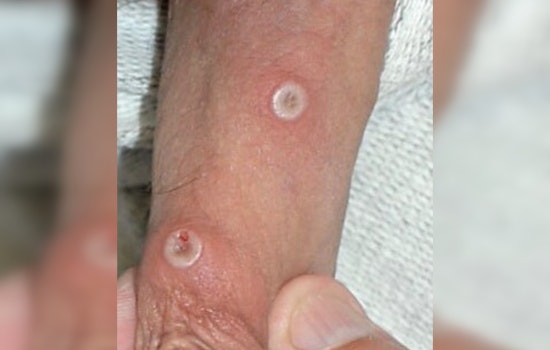 Rare Mpox Strain Lands In St. Louis As Missouri Confirms First Cases