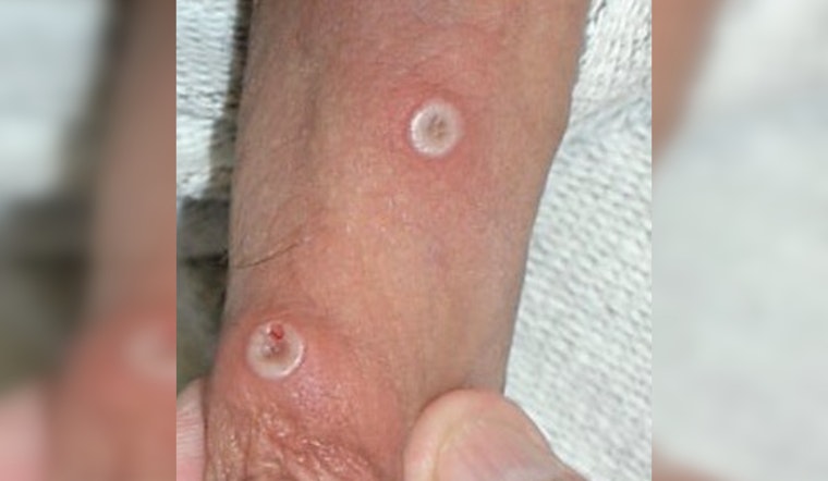 Rare Mpox Strain Lands In St. Louis As Missouri Confirms First Cases