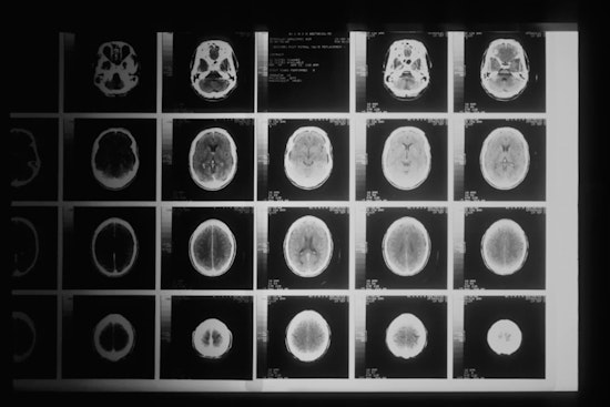 La Jolla Lab Finds Brain ‘Kill Switch’ That Could Stall Alzheimer’s