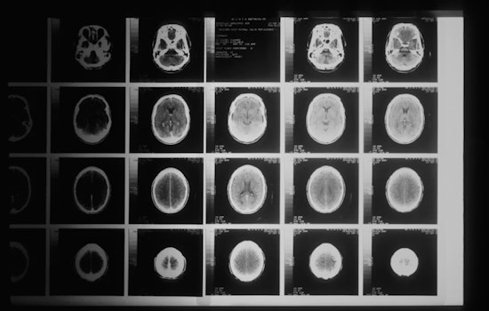 La Jolla Lab Finds Brain ‘Kill Switch’ That Could Stall Alzheimer’s