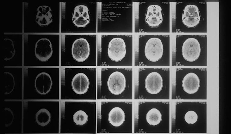 La Jolla Lab Finds Brain ‘Kill Switch’ That Could Stall Alzheimer’s