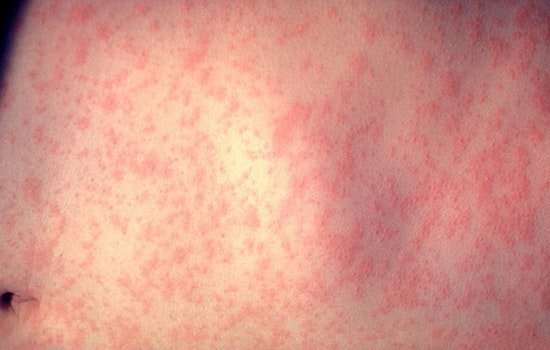 Measles Scare From Weld County Hits Fort Collins Clinics