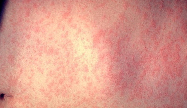 Measles Scare From Weld County Hits Fort Collins Clinics