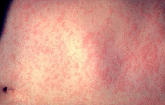Measles Scare Hits King County as Travelers Bring Virus Home