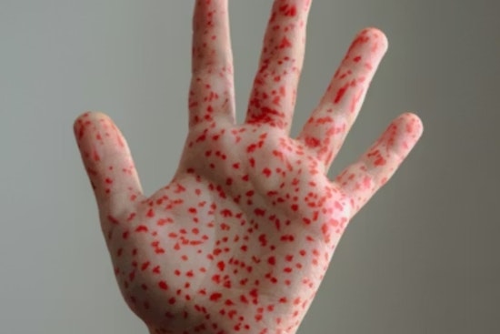 Measles Scare Rattles Monroe County After Church Event And Clinic Visits