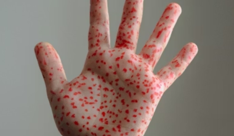 Measles Scare Rattles Monroe County After Church Event And Clinic Visits