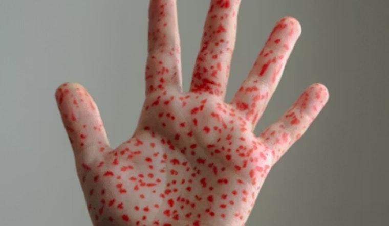 Measles Scare Slams Three Washington County Schools, Parents Put On High Alert
