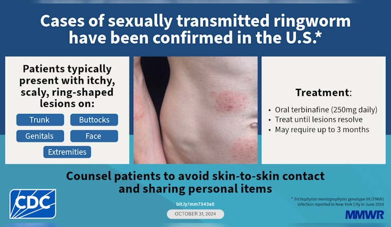 New Sexually Transmitted Fungus Creeps Into King County, Health Officials Sound Alarm