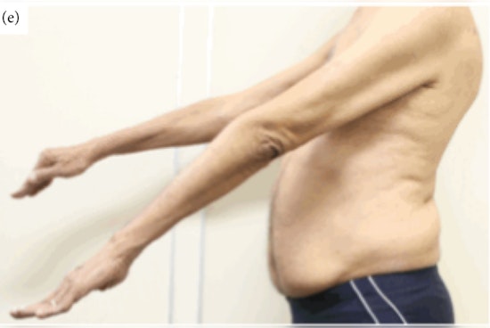 Portland Vet Battles VA as Rare Muscle Disease Steals His Strength