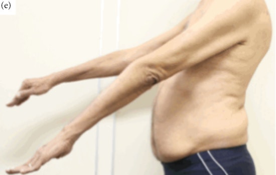 Portland Vet Battles VA as Rare Muscle Disease Steals His Strength