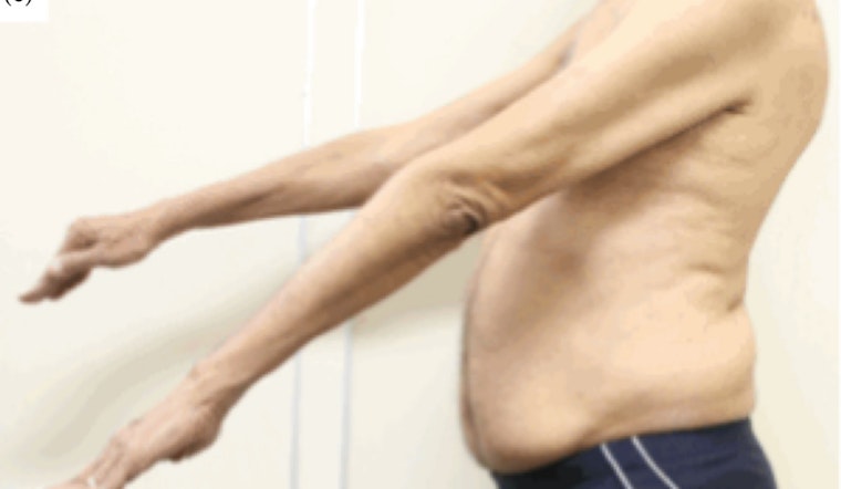 Portland Vet Battles VA as Rare Muscle Disease Steals His Strength
