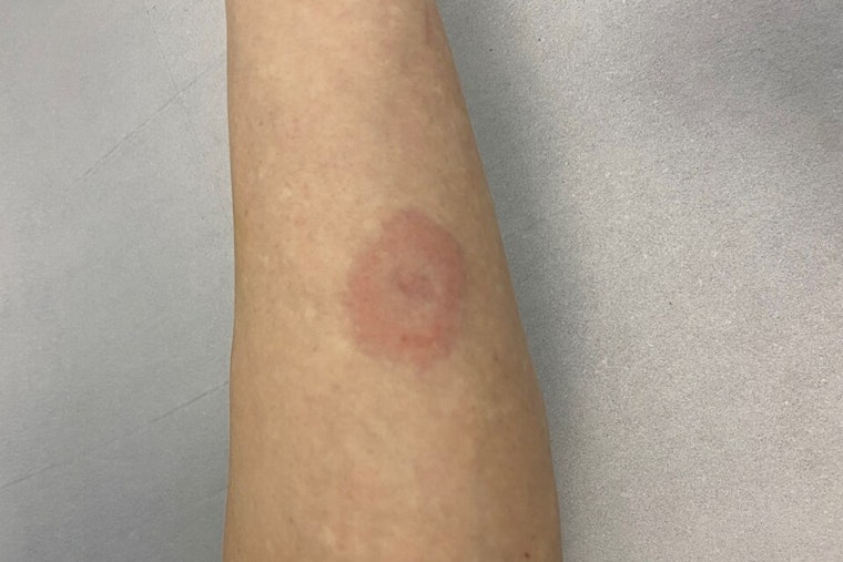 Ticked Off: Michigan Under Siege As Lyme Cases Explode Statewide