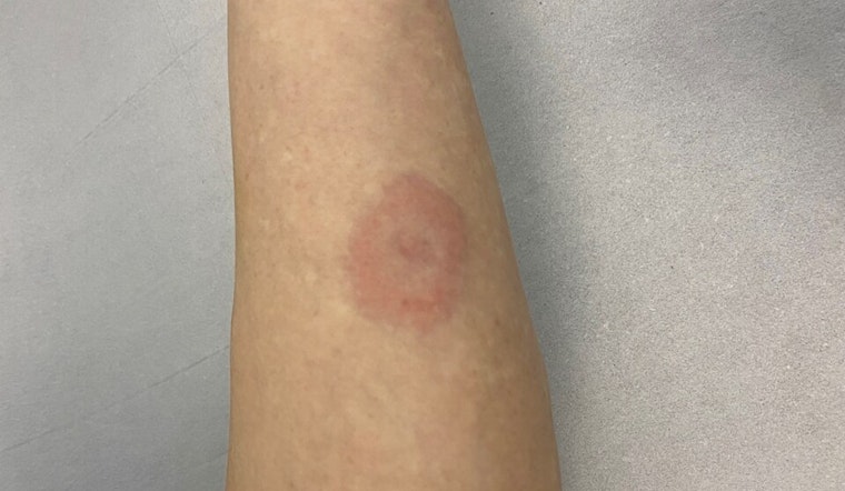Ticked Off: Michigan Under Siege As Lyme Cases Explode Statewide