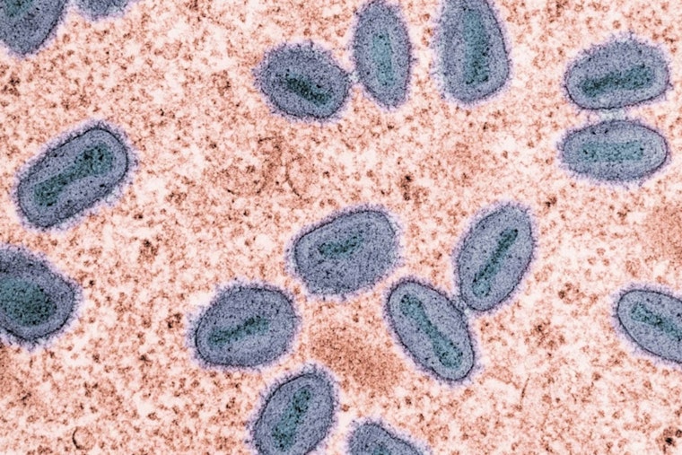 Unvaccinated SF Patient Hospitalized in City's First Potent Mpox Case