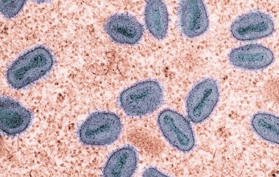 Unvaccinated SF Patient Hospitalized in City's First Potent Mpox Case