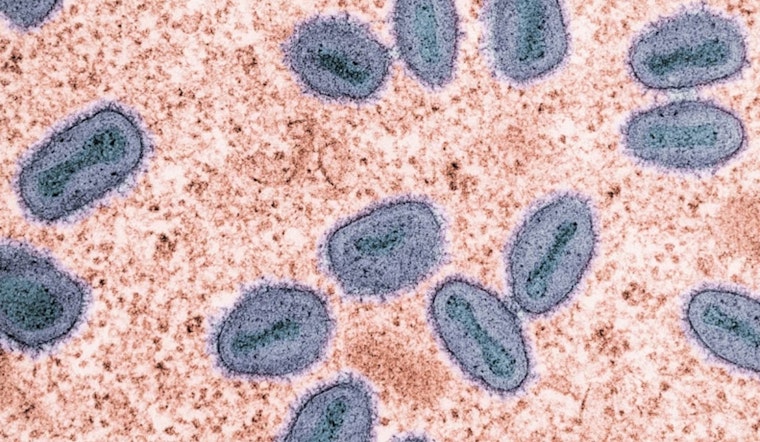Unvaccinated SF Patient Hospitalized in City's First Potent Mpox Case