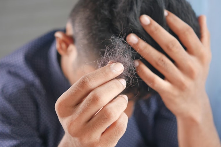 Bay Area Shock As UCSF Links Ozempic-Style Slimdown Shots To Sudden Hair Shedding