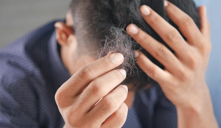 Bay Area Shock As UCSF Links Ozempic-Style Slimdown Shots To Sudden Hair Shedding