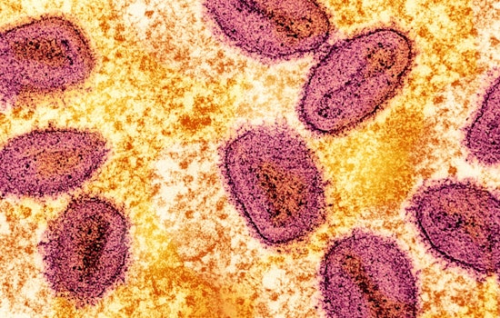 Boston Mpox Cases Creep Up As Pride Nears, City Ramps Up Shots