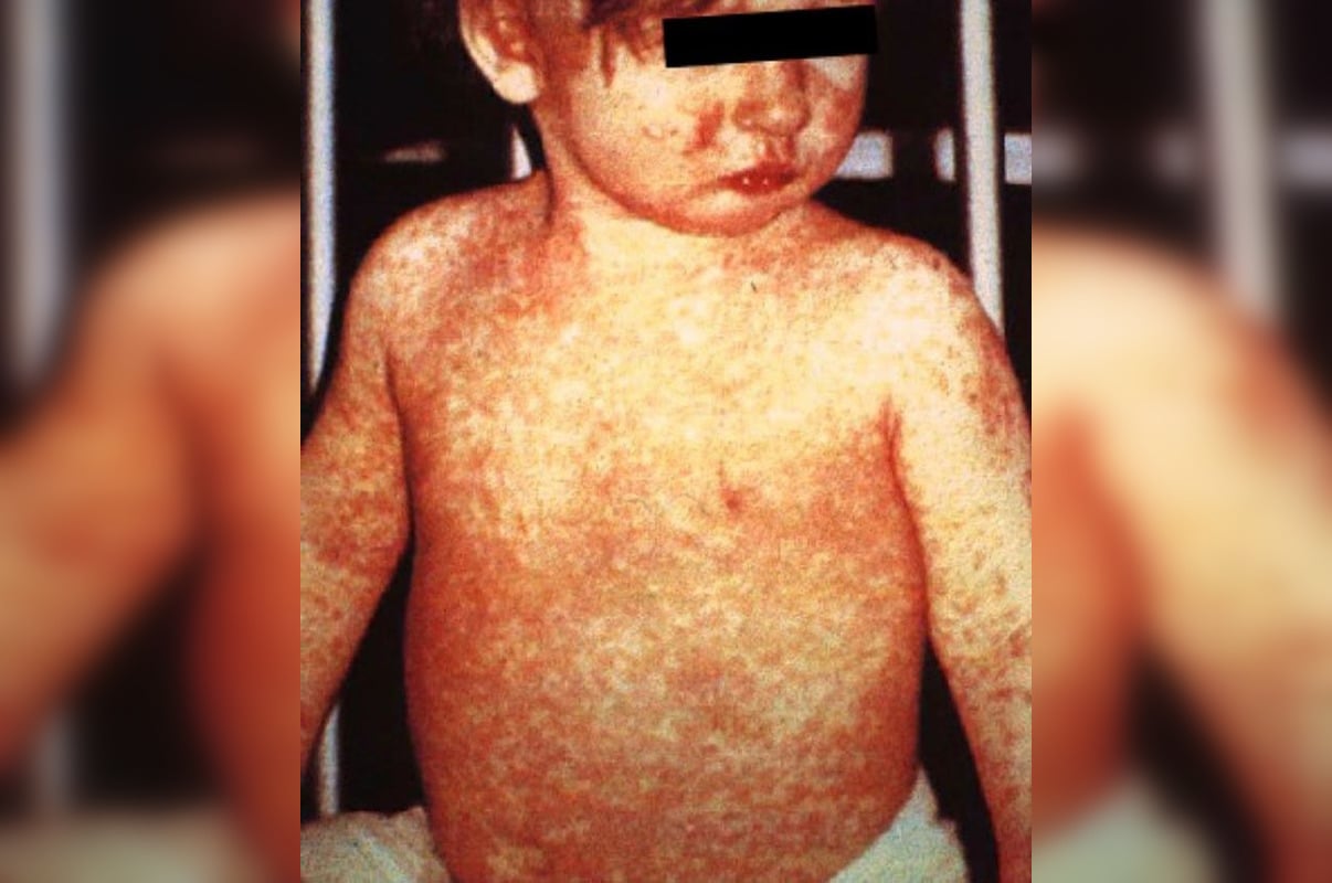 CDC Finds High Hospitalization Rate in West Texas Measles Outbreak