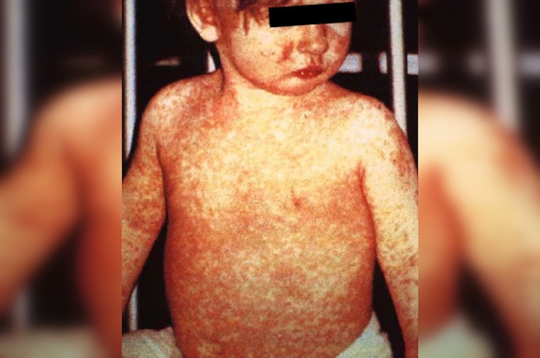 CDC Finds High Hospitalization Rate in West Texas Measles Outbreak
