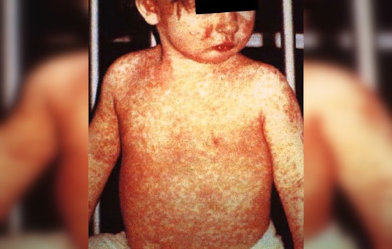 CDC Finds High Hospitalization Rate in West Texas Measles Outbreak
