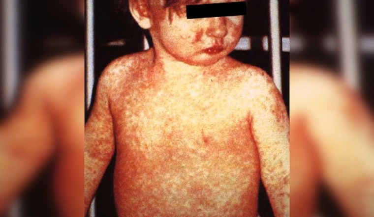 CDC Finds High Hospitalization Rate in West Texas Measles Outbreak