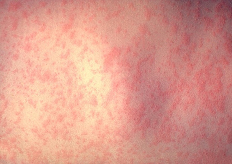 L.A. County Confirms Fifth Measles Case Linked to LAX