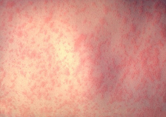 L.A. County Confirms Fifth Measles Case Linked to LAX