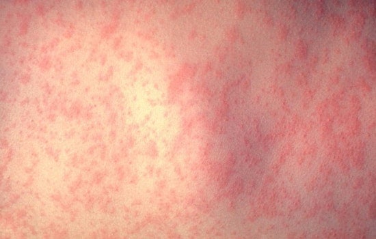 L.A. County Confirms Fifth Measles Case Linked to LAX