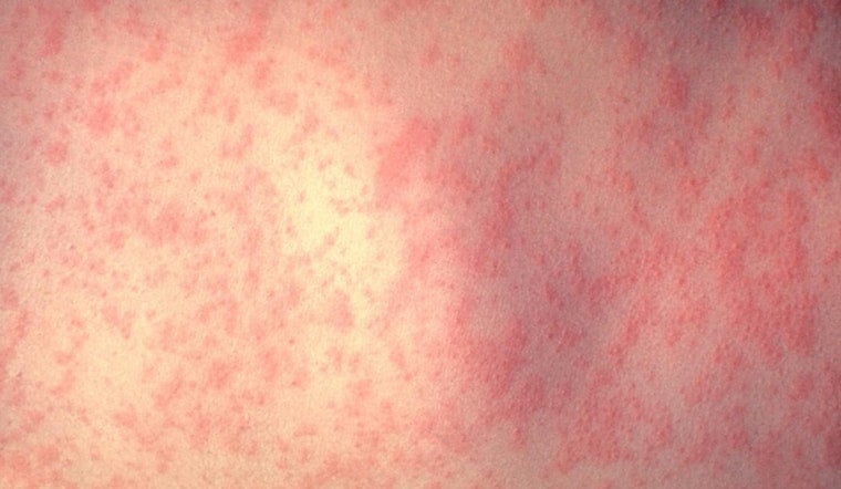 L.A. County Confirms Fifth Measles Case Linked to LAX