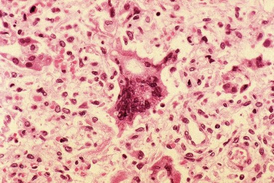 Measles Scare Hits Hell's Kitchen After Sick Diner Visits Norma