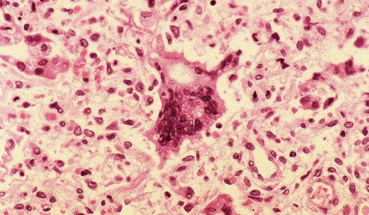 Measles Scare Hits Hell's Kitchen After Sick Diner Visits Norma