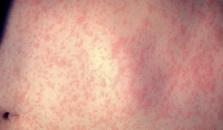 Measles Scare Hits Met Opera Crowd After Mystery April Performance
