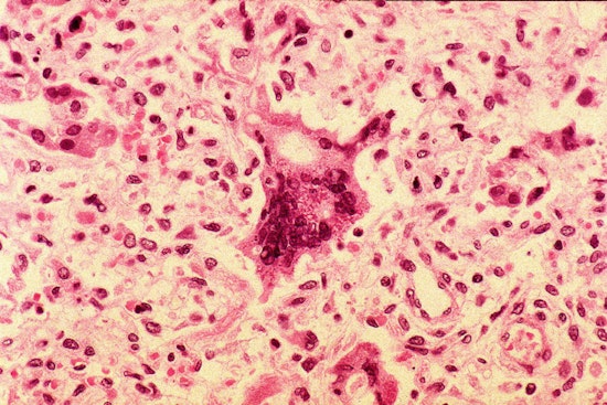 Measles Scare Hits Orange County After Infant Returns From Trip Abroad