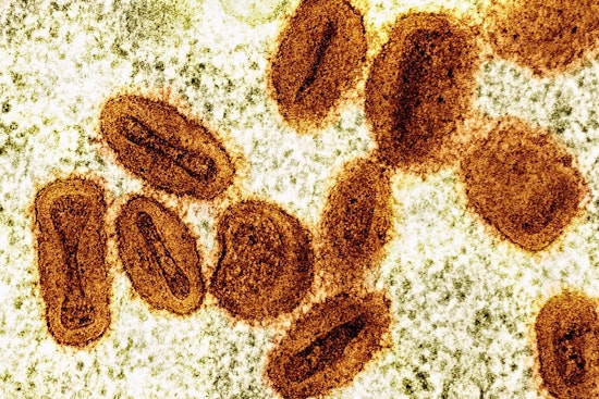Mpox Pockets Pop Up Across Wisconsin As Health Officials Sound the Alert