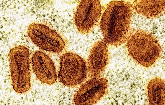 Mpox Pockets Pop Up Across Wisconsin As Health Officials Sound the Alert