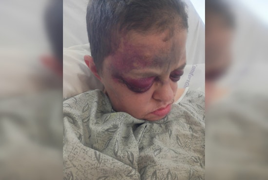 Bruised And Hospitalized, Midwest City Mom’s Nursing Home Stay Sparks Probe