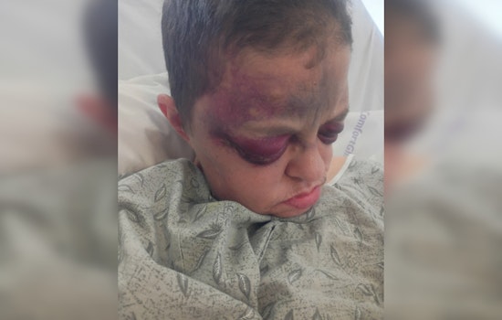 Bruised And Hospitalized, Midwest City Mom’s Nursing Home Stay Sparks Probe