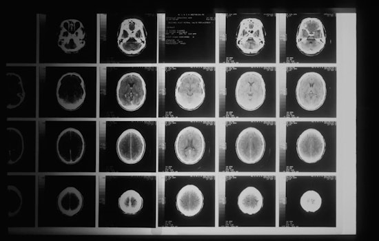 SF Brain Zapper Learns Patients' Steps, Cuts Parkinson's Stumbles